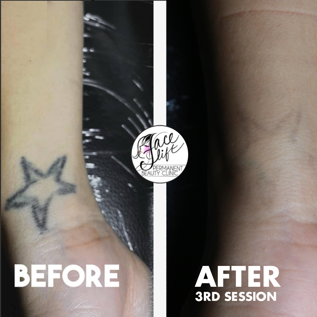 Laser Tattoo Removal in West Bloomfield  Affordable  Chroma Tattoo